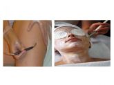 Promoção 2 - 8 Sessões de Trat. de estrias + Limpeza Facial